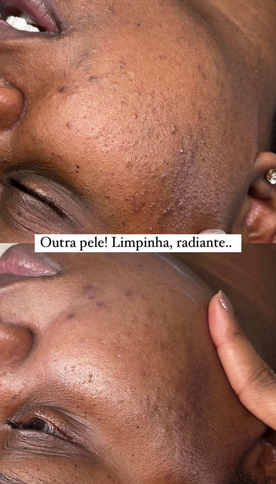 Limpeza de Pele Let