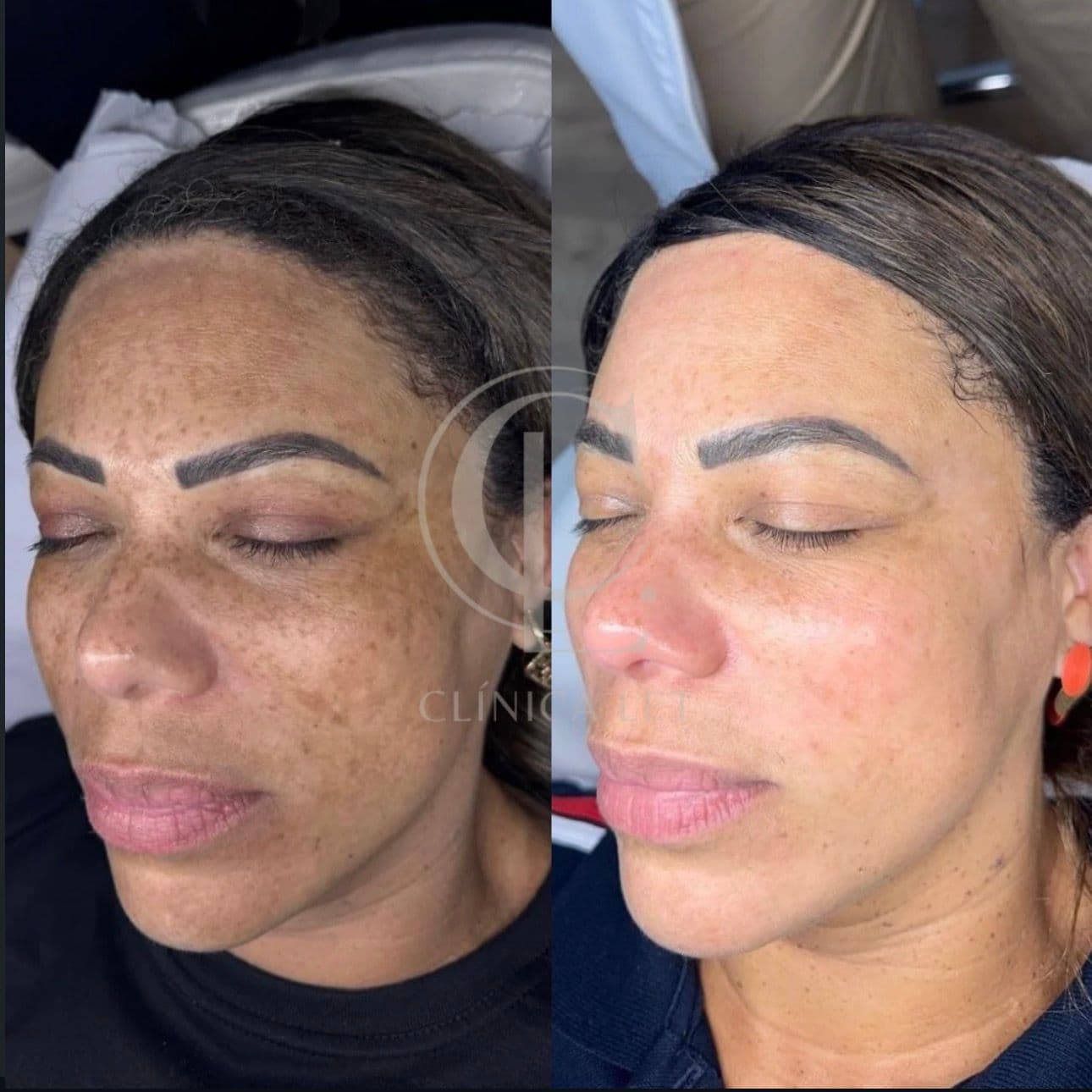 LiberLet Melasma